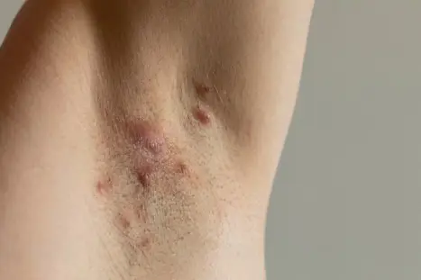 Et nærbilde av en persons hud