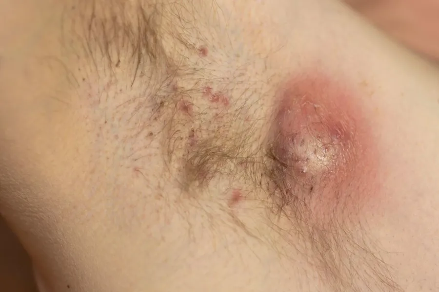 Nærbilde av en persons hårete hud