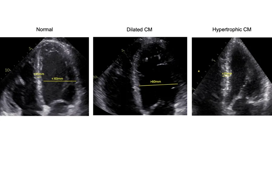 Cardiac ultrasound view of a normal heart, Dilated cardiomyopathy (DCM) and Hypertrophic cardiomyopathy (HCM).
