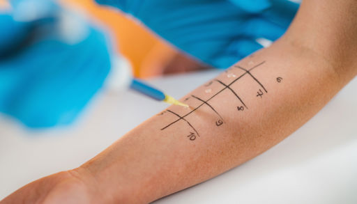 Bilde av en arm med flere firkanter som brukes til å teste for allergi