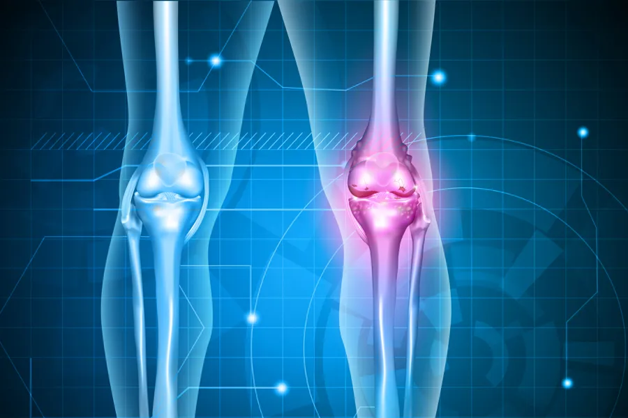 røntgen av knær