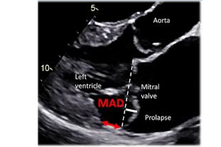 Ultralydbilde av hjerte som viser MVP/MAD