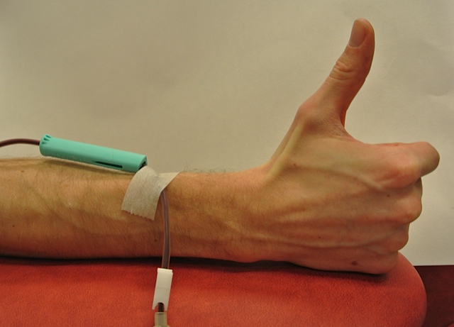 En persons hånd og underarm med et rør festet til den og tommelen opp