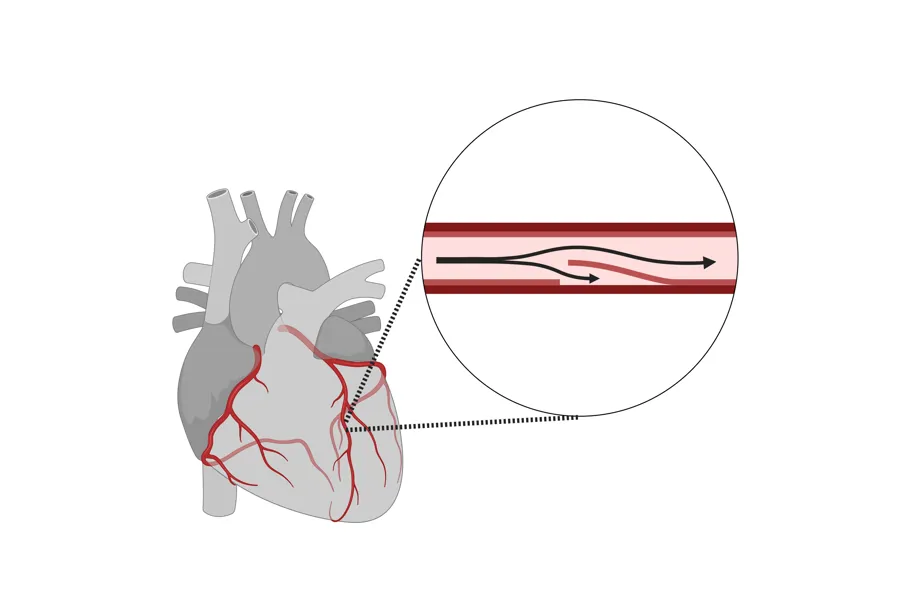 Illustrasjonsbilde som viser spontan koronar arteriedisseksjon (SCAD) i en kransåre.