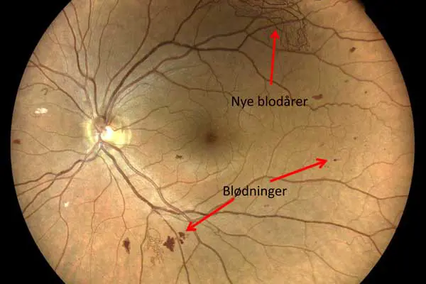 Illustrasjonsbilde av Diabetesretinopati