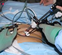 Laparoskopi-nerme.jpg
