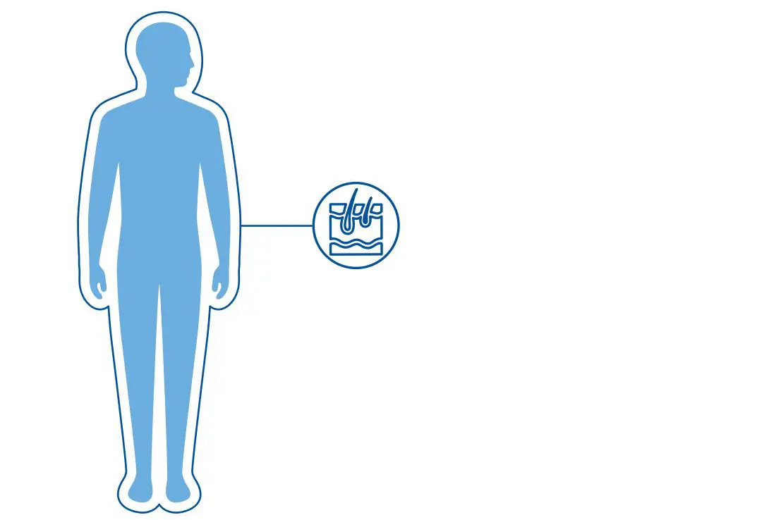 Diagnoseillustrasjon av iktyose