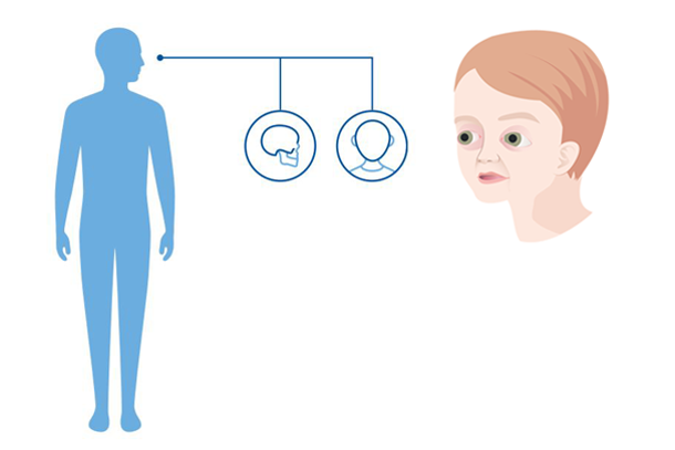 Diagnoseillustrasjon av hvilke kroppsdeler Crouzon syndrom påvirker: kraniet