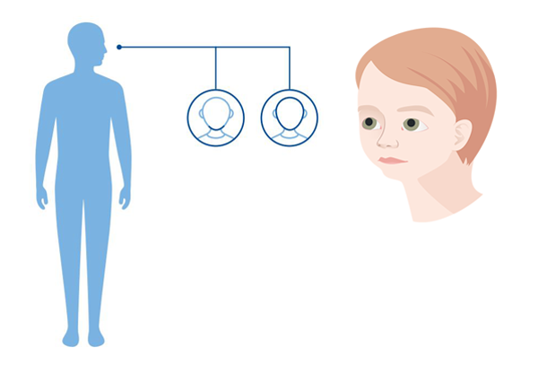 Diagnoseillustrasjon av Pierre Robin sekvens