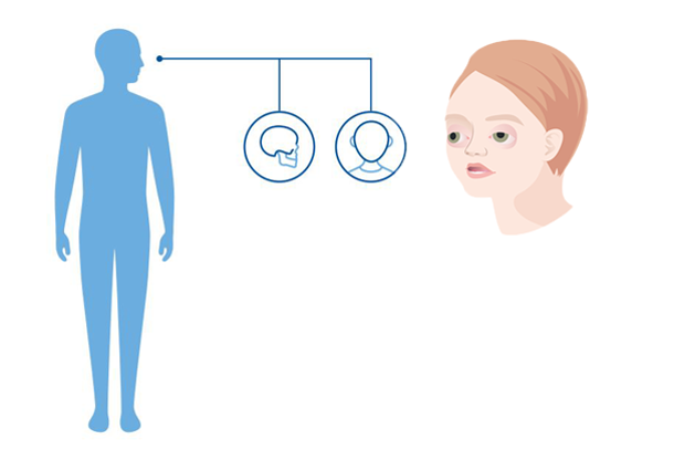 Diagnoseillustrasjon av Pfeiffer syndrom