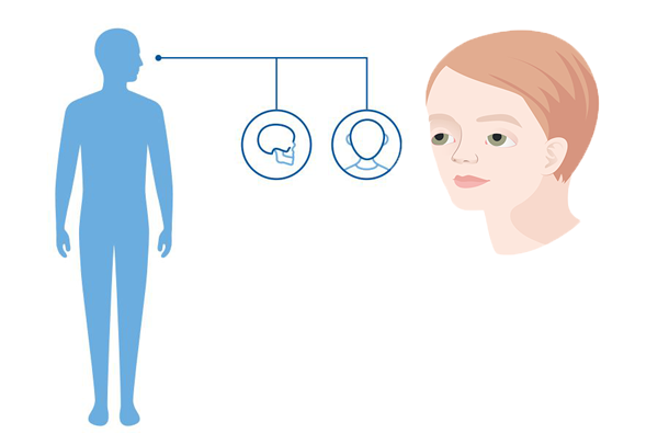 Diagnoseillustrasjon som viser hvilke kroppdel Muenke syndrom påvirker: Kraniet
