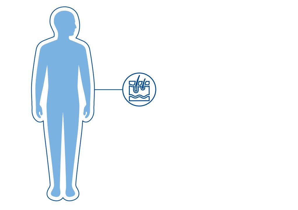 Illustrasjon av en menneskekropp med et uthevet symbol av hud som viser at EB rammer huden. 