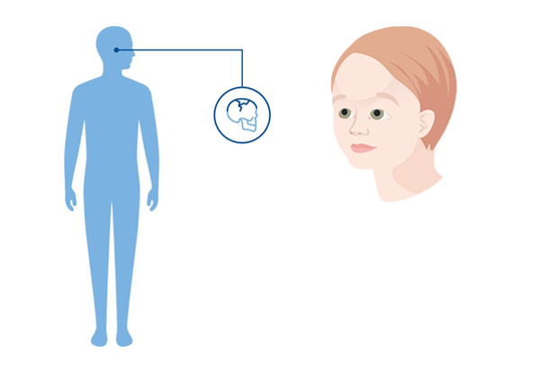 Diagnoseillustrasjon av hvilke kroppsdel metopicasynostose påvirker: Kraniet