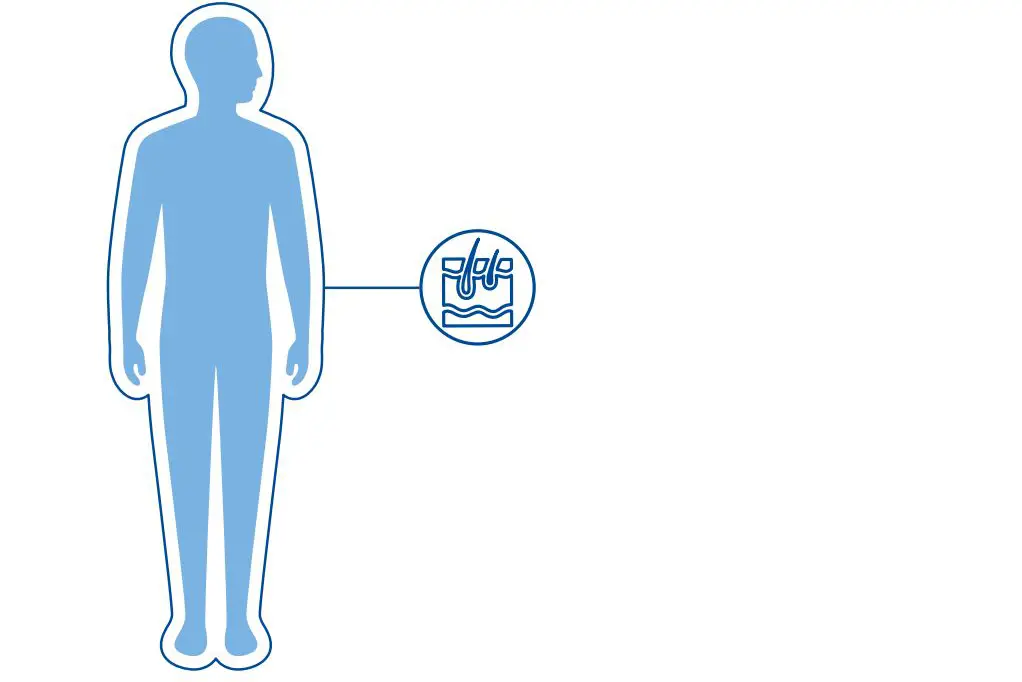 Illustrasjon av en menneskekropp med et uthevet symbol av hud som viser at EB påvirker huden.