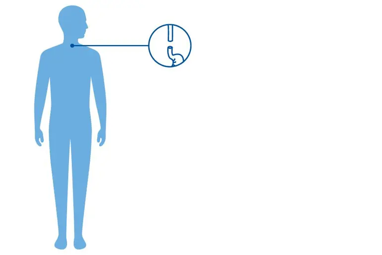 Illustrasjon av en blå menneskekropp og et ikon av et delt spiserør, beskrivende for den sjeldne diagnosen øsofagusatresi