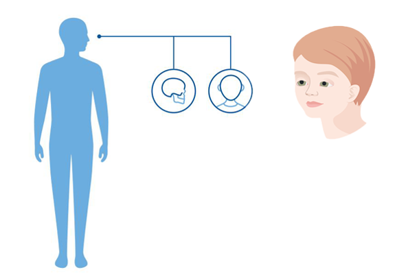 Diagnoseillustrasjon av Sæthre-Chotzen syndrom