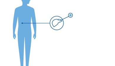 Diagnoseillustrasjn av Galatosemi