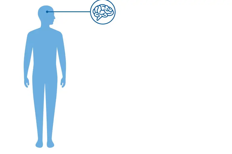 Huntingtons sykdom er en arvelig hjernesykdom. Diagnoseillustrasjon av Huntingtons sykdom