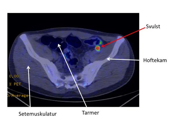 Bilde viser svulst i bekkenet ved Gallium-PET