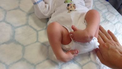 Bilde av baby med klumpfot
