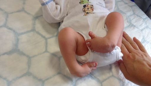Bilde av baby med klumpfot