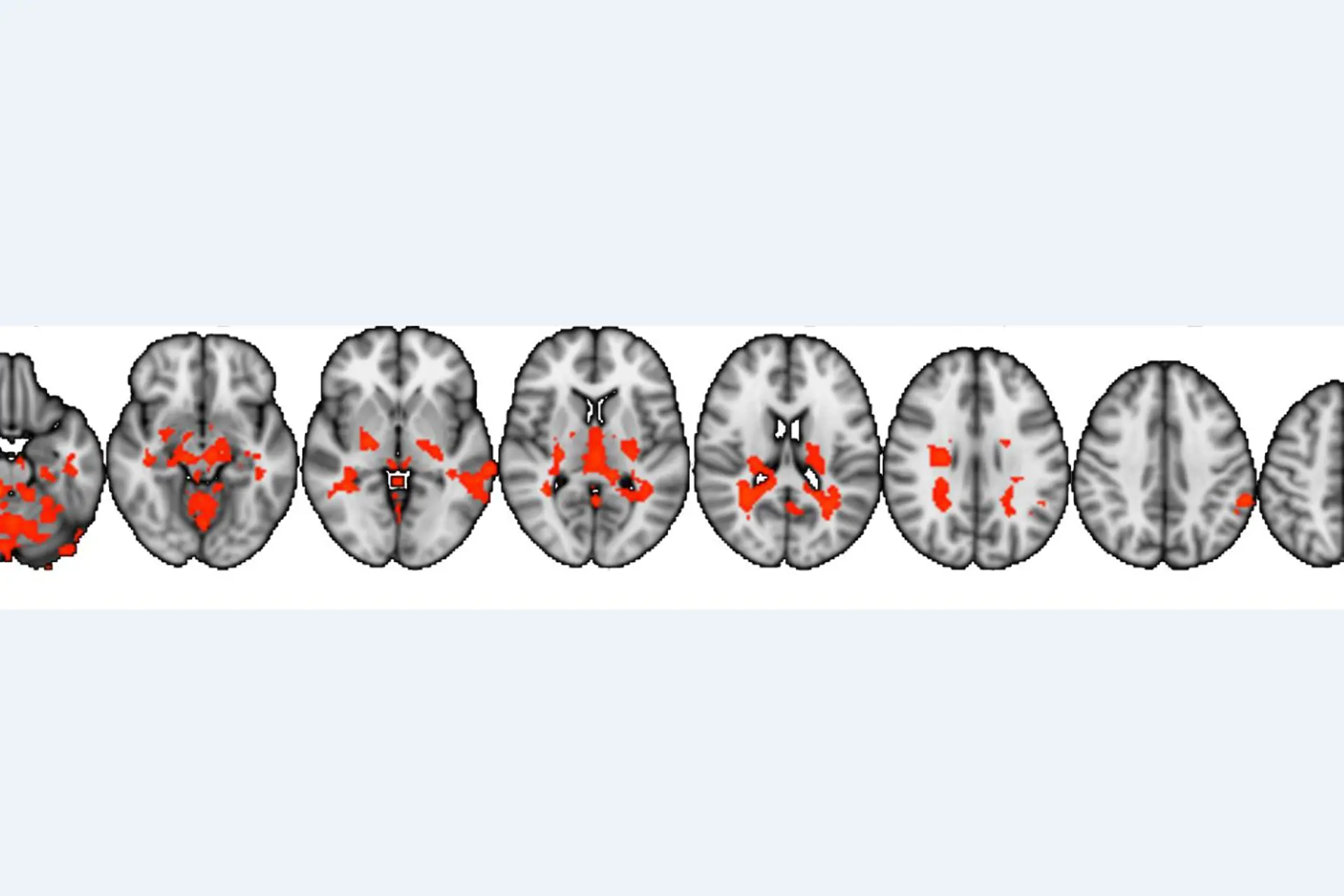 figur1: Hjernescanninger