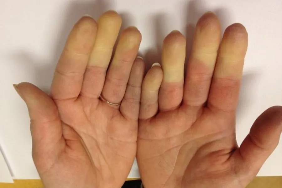 Bilde av hender - Raynauds fenomen