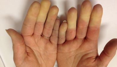Bilde av hender - Raynauds fenomen