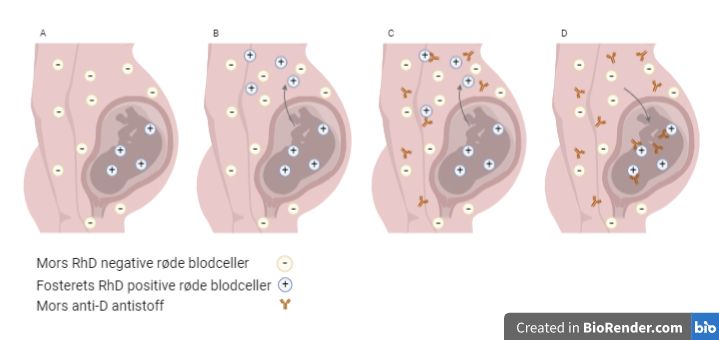 Illustrasjon av RhD immunisering i svangerskapet