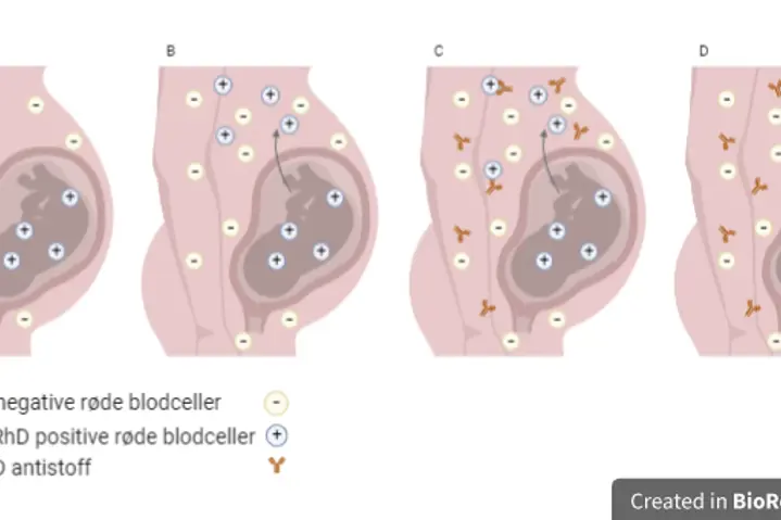 Illustrasjon av RhD immunisering i svangerskapet