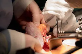 En nyre flres inn i byken til et menneske.