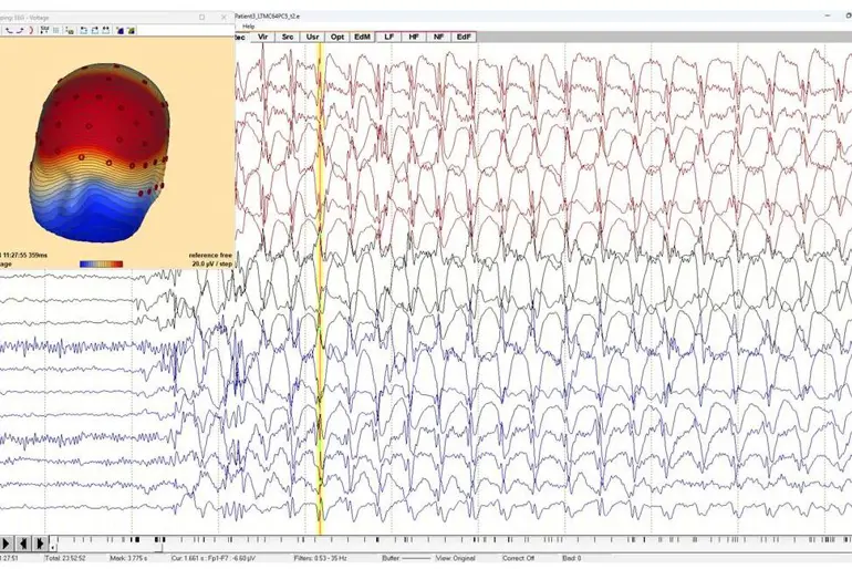 Bilde av hjerneaktivitet ved et epileptisk anfall