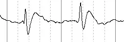 Diagram som viser skarpe hjernebølger - spike-waves