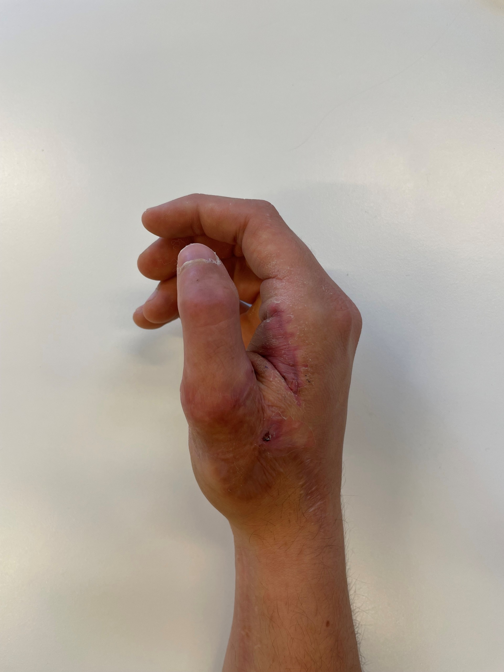 En hånd med en blodig tommel