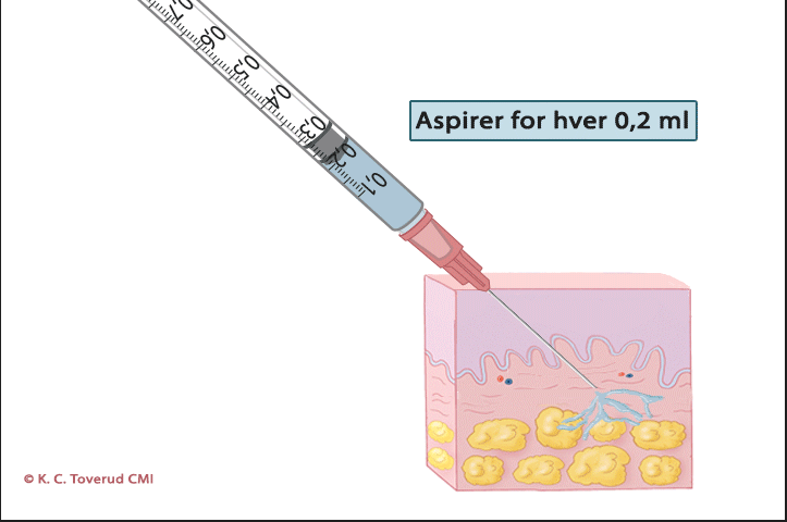 Dyp subkutan injeksjonsteknikk
