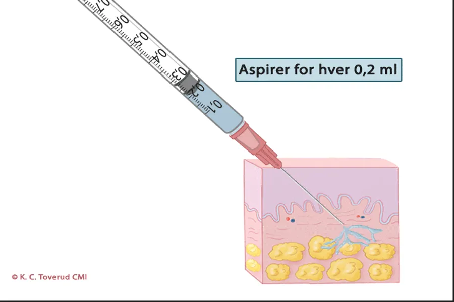 Dyp subkutan injeksjonsteknikk