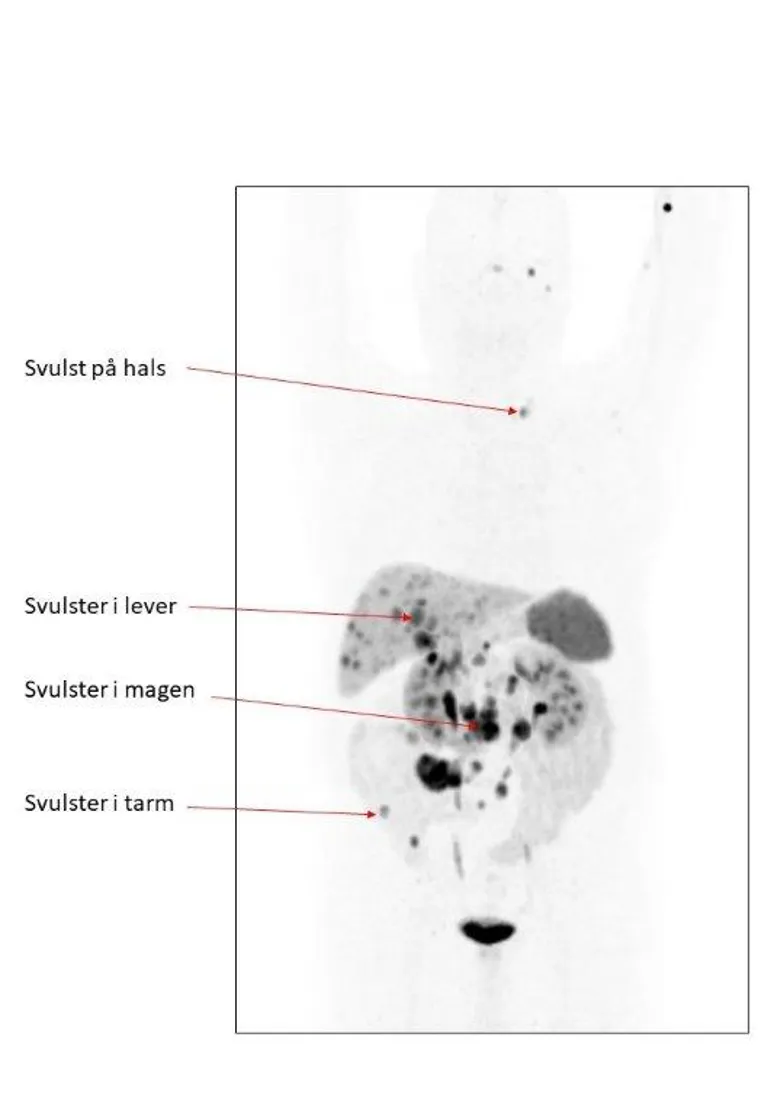 Bildet viser Gallium-PET som viser svulster i lever, hals, og i mage