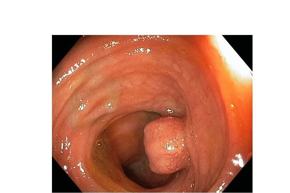 Bildet viser svulst i tynntarmen sett ved kolonoskopi (undersøkelse av tykktarmen) Svulsten er 15 mm stor